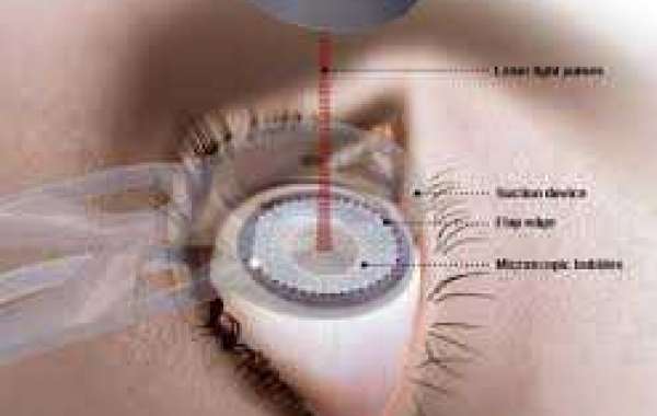 Laser Eye Operation လေဆာနဲ့ မျက်မှန်မလိုအောင်လုပ်ခြင်း