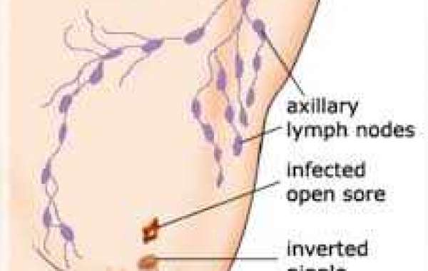 Male breast cancer ယောက်ျားရင်သားကင်ဆာ နှင့် မေးတာသာဖြေတယ်