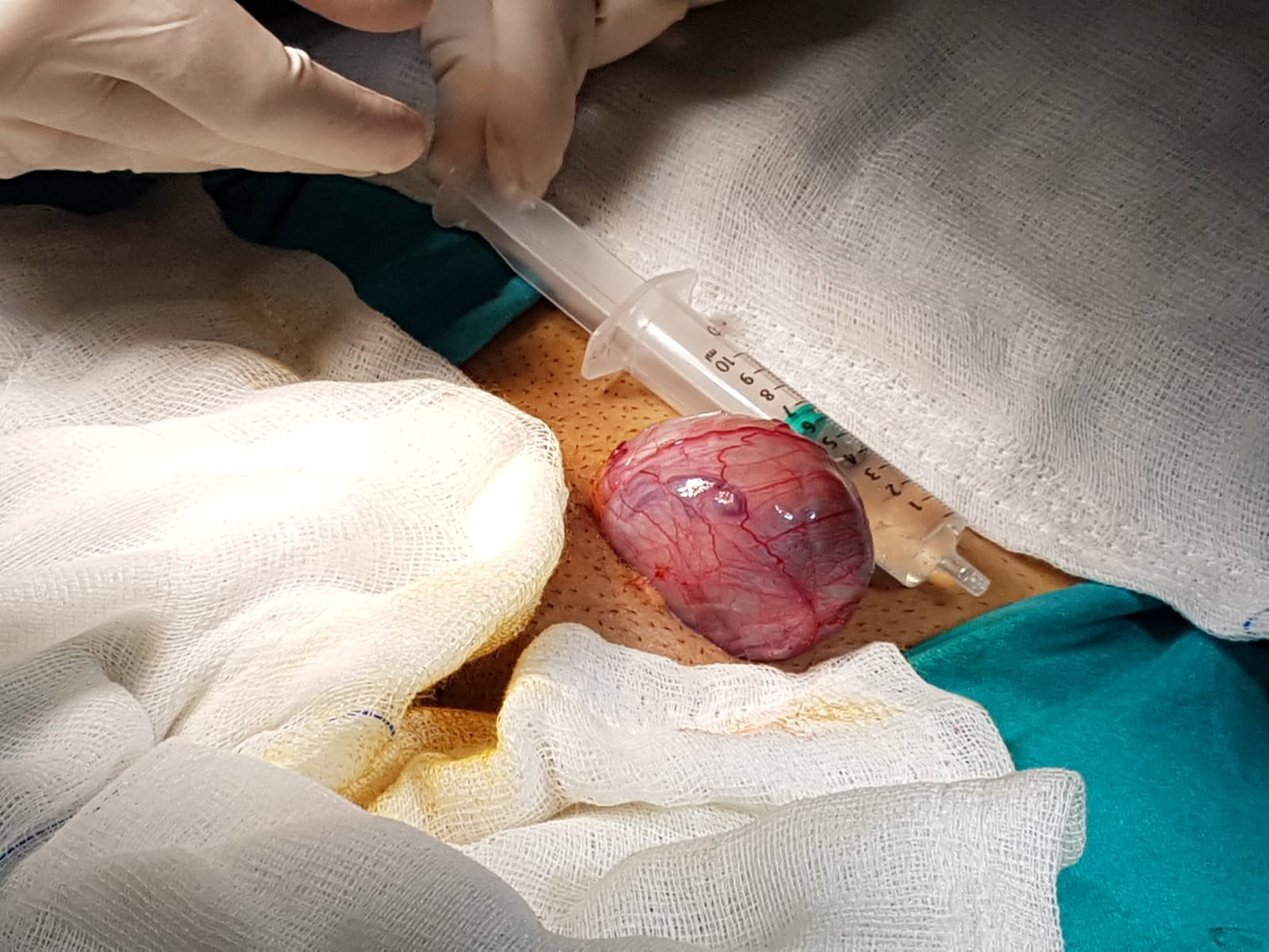 Testis Kanseri Nedir? Testis (Yumurtalık) Kanseri Belirtileri ve Tedavisi