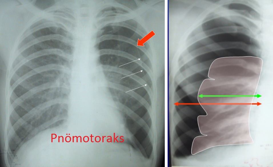 Pnömotoraks Belirtileri, Tanı ve Tedavi Yöntemleri | Prof. Dr. Adalet Demir