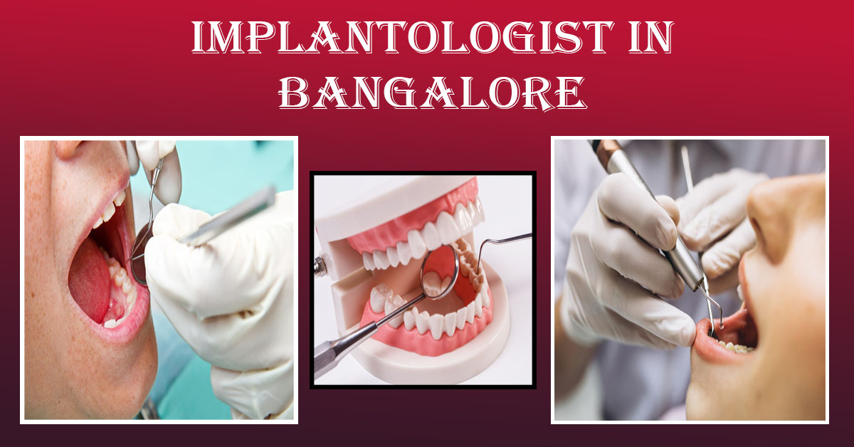 Best Dental Implants in Bangalore | Best Implantologist