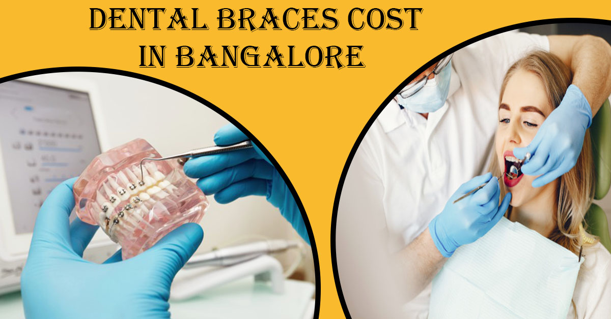 Best Dentist for Braces in Bangalore | Best Dental Clinic