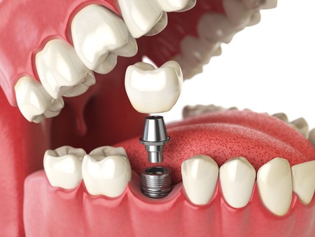 Reasons And Indications That You Need Dental Implants | TechPlanet